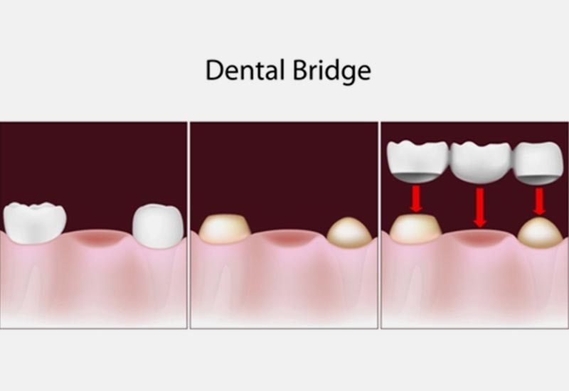 dental bridges near you
