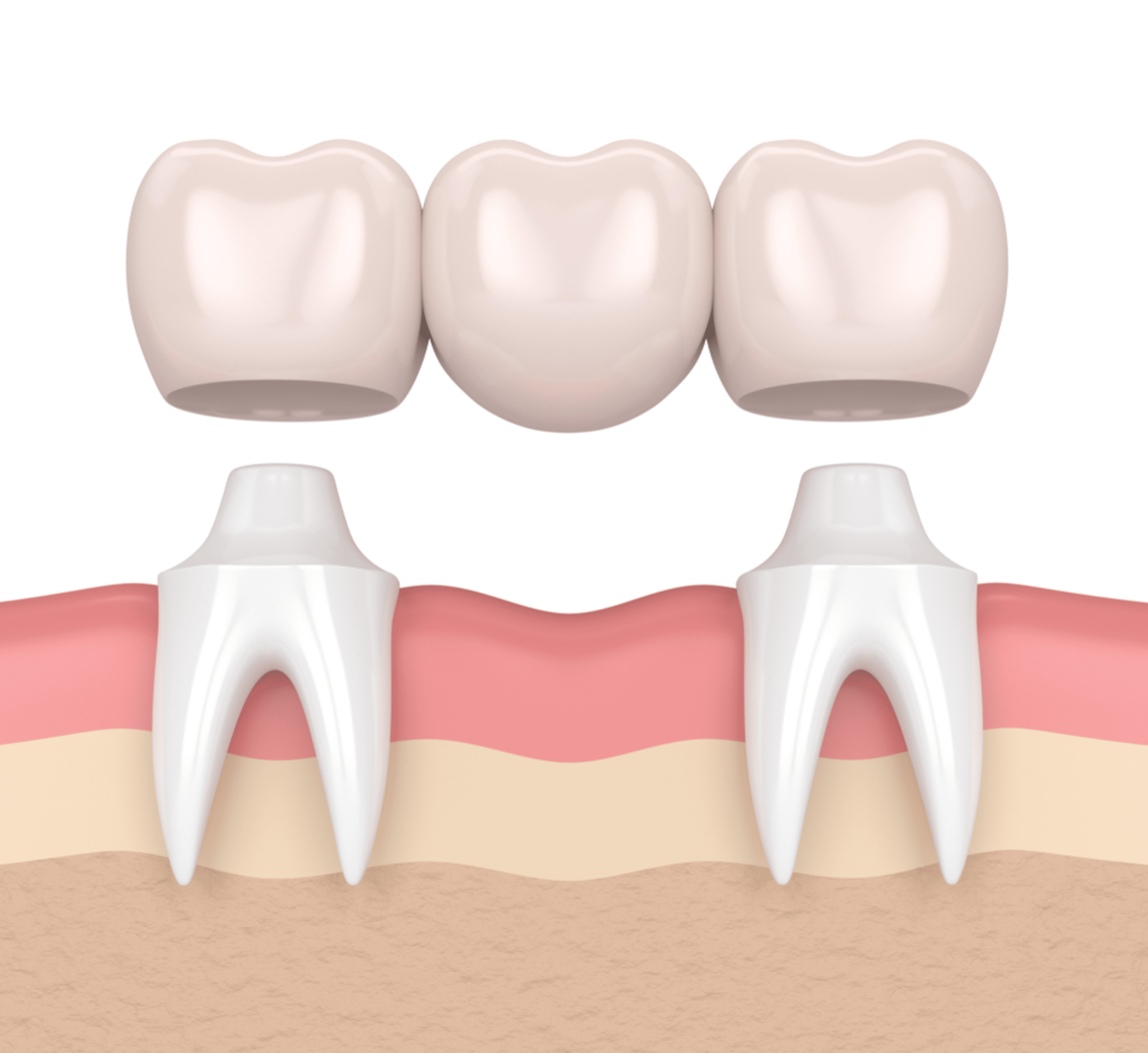 are dental bridges safe and long lasting