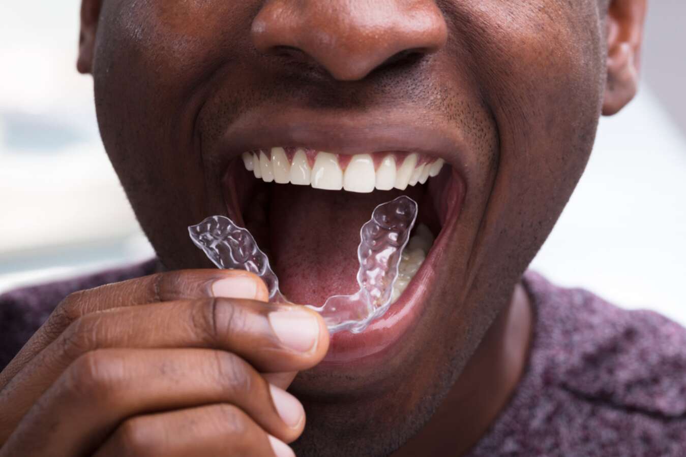 benefits of hybrid orthodontic treatment