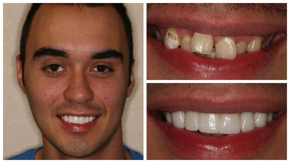 porcelain veneers