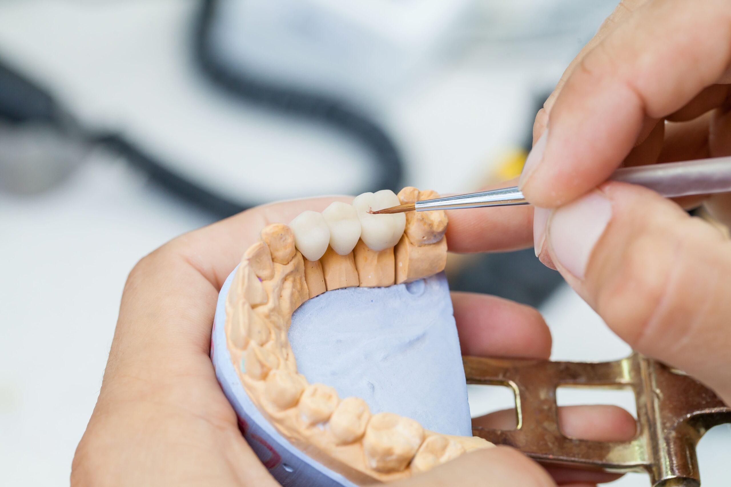 the durability of dental bridges how long can you expect them to last