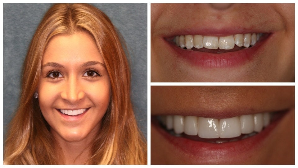 dental implants treatment result