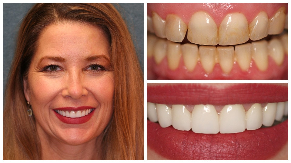 in office teeth whitening