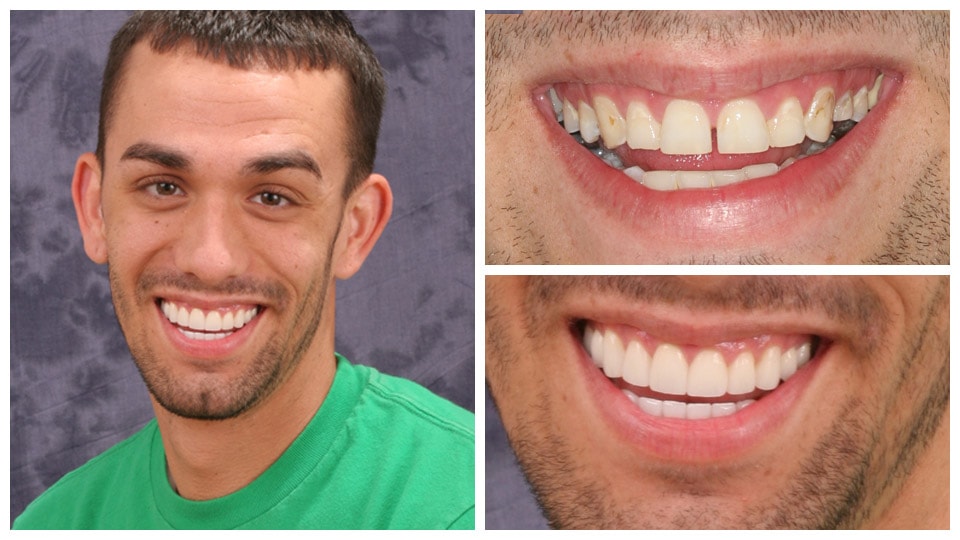 invisalign treatment south tampa