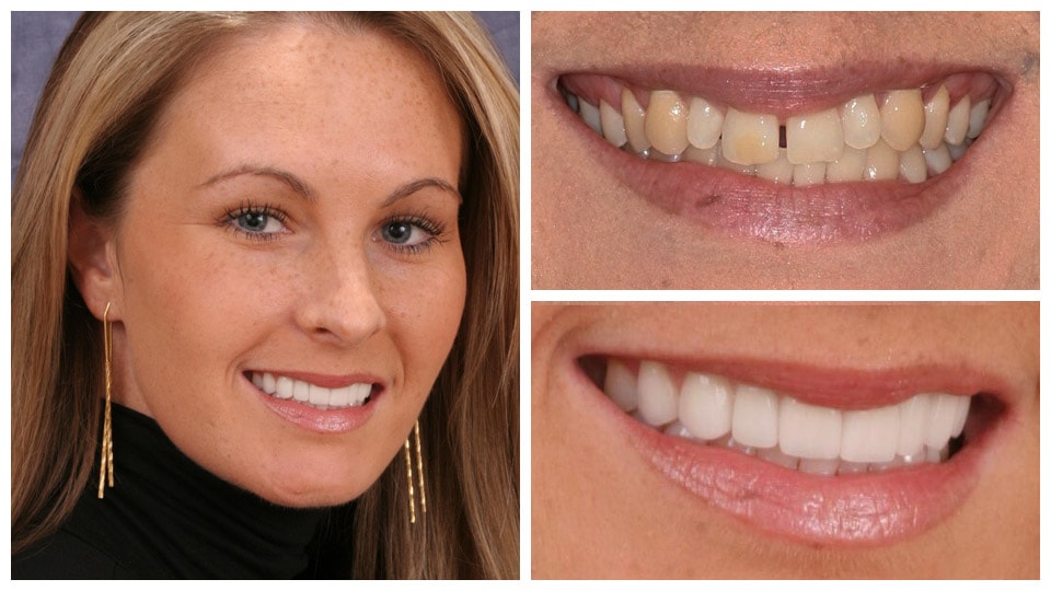 professional teeth whitening treatment result