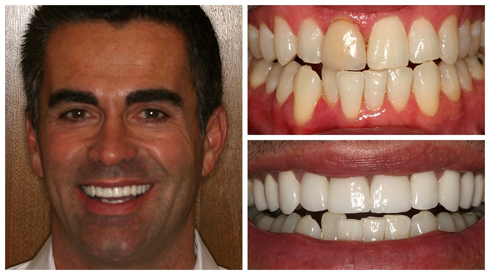 teeth after dental treatment