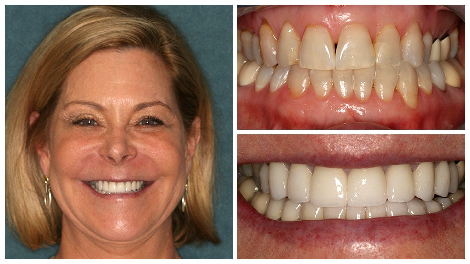 teeth after treatment