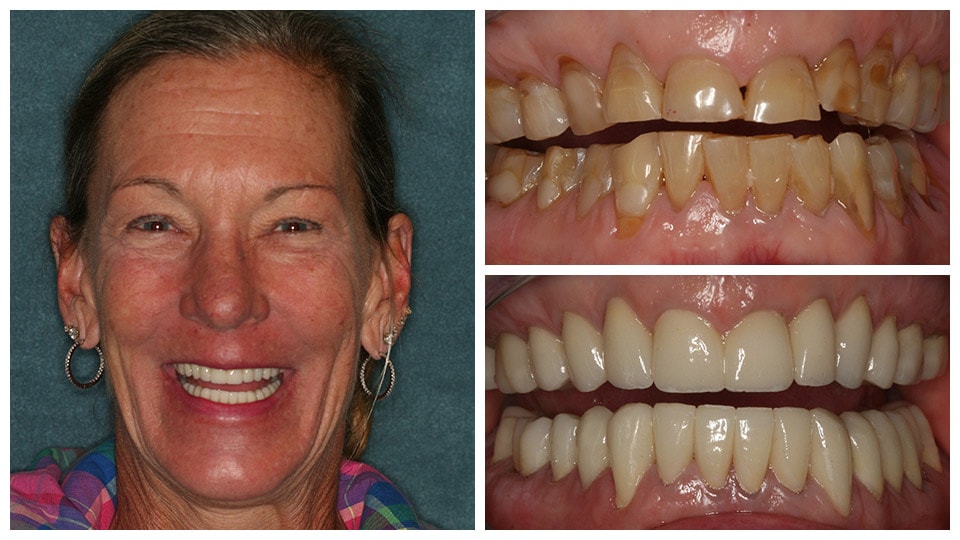 teeth whitening result